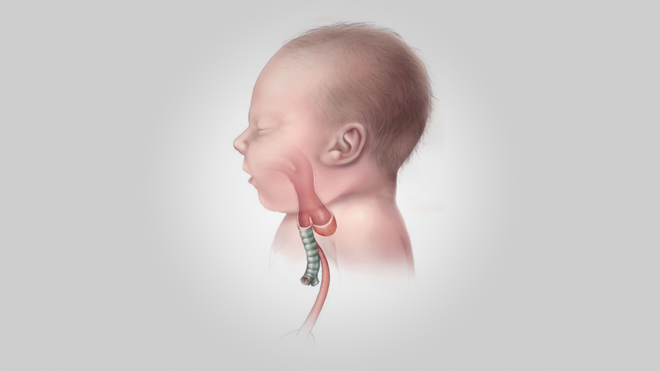 Congenital atresia