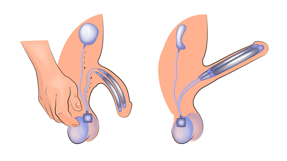 Penile Implants