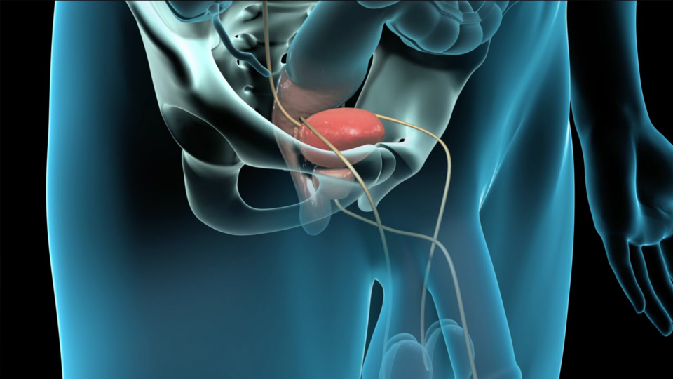 Prostatectomy