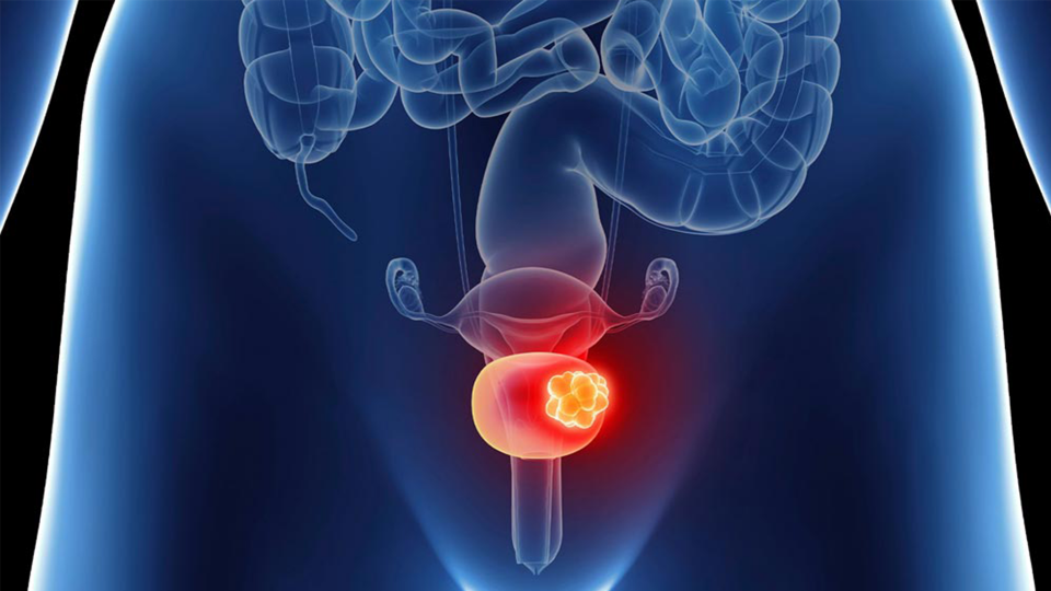 Bladder cancer