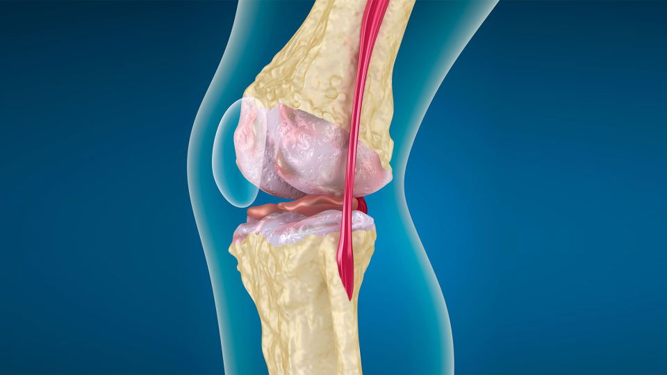 Gonarthrose