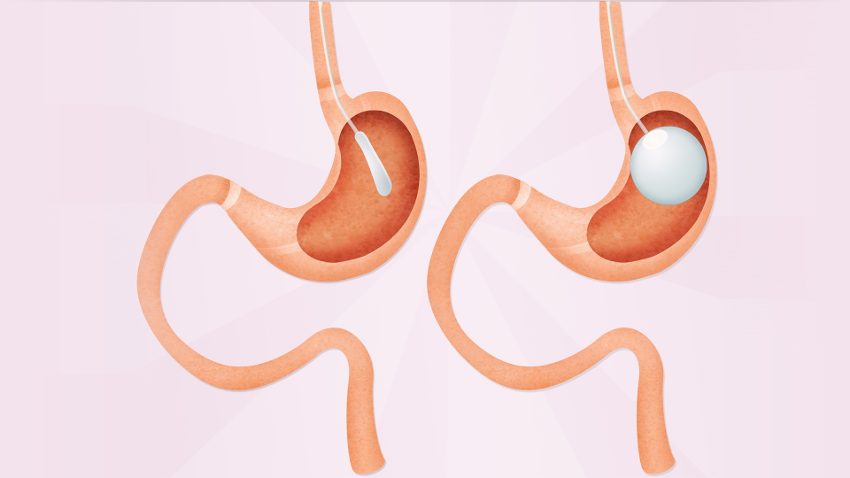Gastric Balloon