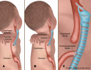 WHAT IS TRACHEOESOPHAGEAL FISTULA?