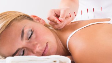Acupuncture
