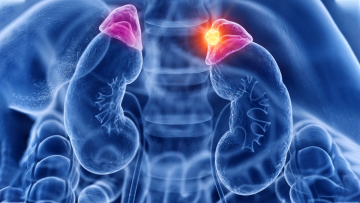 Adrenal kanser