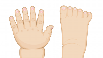 Congenital anomaly