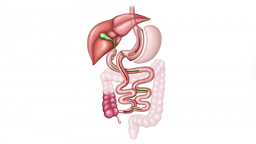 Duodonal Switch (Biliopankreatische Diversion)