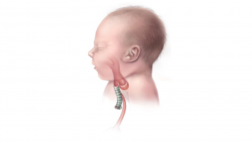 ESOPHAGEAL ATRESIA