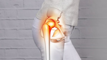 Hip Calcification: Causes, Symptoms, Treatment 