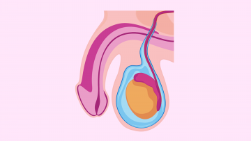 Hydrocele