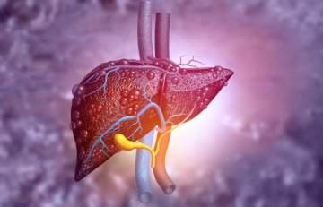 Liver cancer