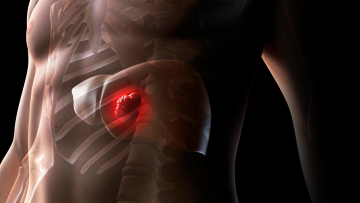 Liver cyst