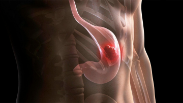 Stomach Cancer