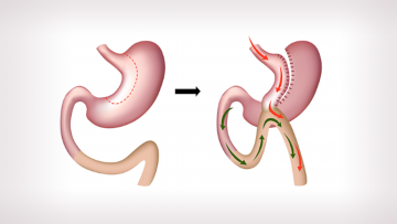 Gastrik Bypass