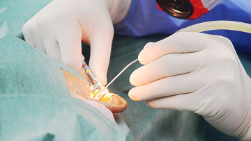 Modified Radical Mastoidectomy