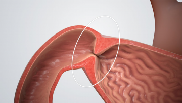 Pyloromyotomy