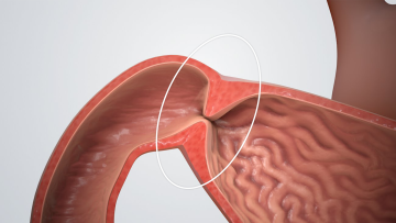 Pyloric Stenosis 