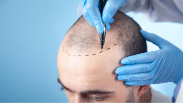 Haartransplantation