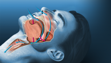 Sleep apnea