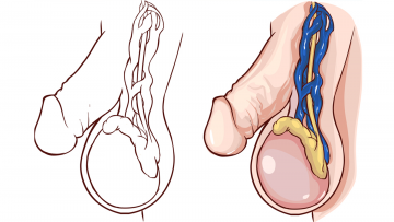 Varicocele