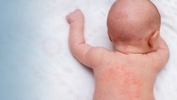 What is a Rash? How Does a Rash Heal?