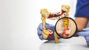 Was sind entzündliche Darmerkrankungen?