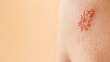 What Is Shingles? Symptoms and Treatment