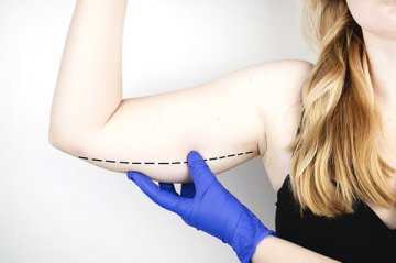 Arm Lift