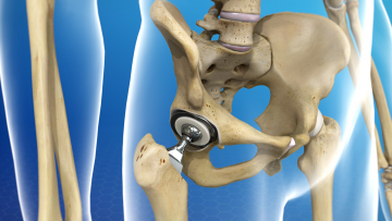 Arthroplastik