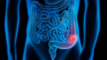 Intestinal cancers