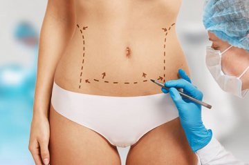 Abdominoplasty