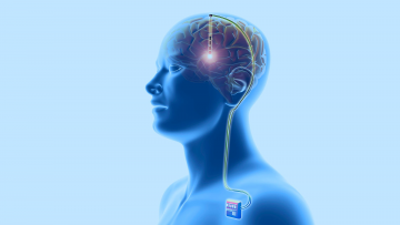 Deep brain stimulation
