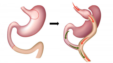 MINI GASTRIC BY-PASS