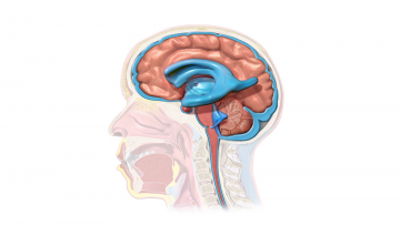 Hydrocephalus