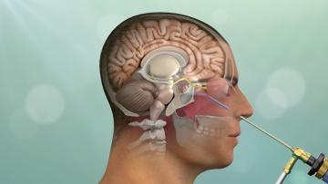 Pituitary surgery