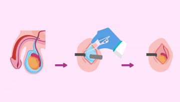 Hydrocelectomy