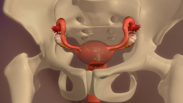 Vaginal Hysterectomy