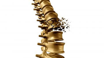 Traumatic Spine Fractures