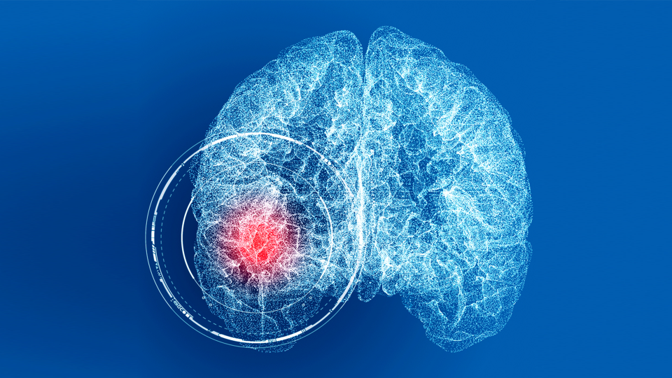 WHAT IS AN ANEURYSM?