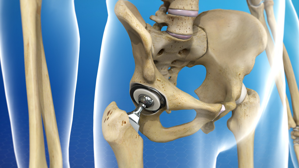 WHAT IS ARTHROPLASTY?