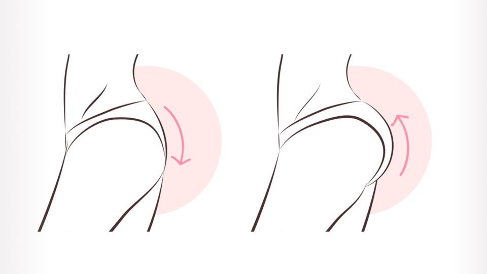 WHAT IS BRAZILIAN BUTT LIFT?