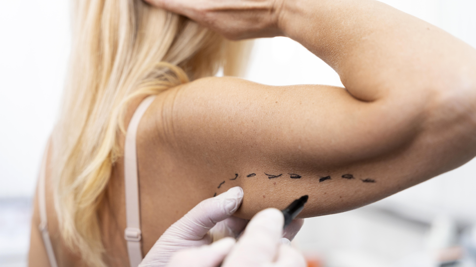 Why is Arm Lift Surgery Performed?