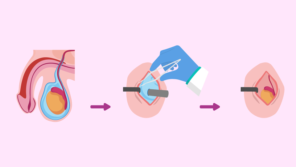Types of Hydrocele