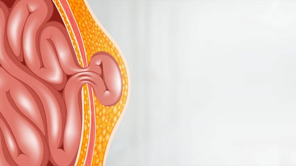 WHAT IS INGUINAL HERNIA IN INFANTS AND CHILDREN?