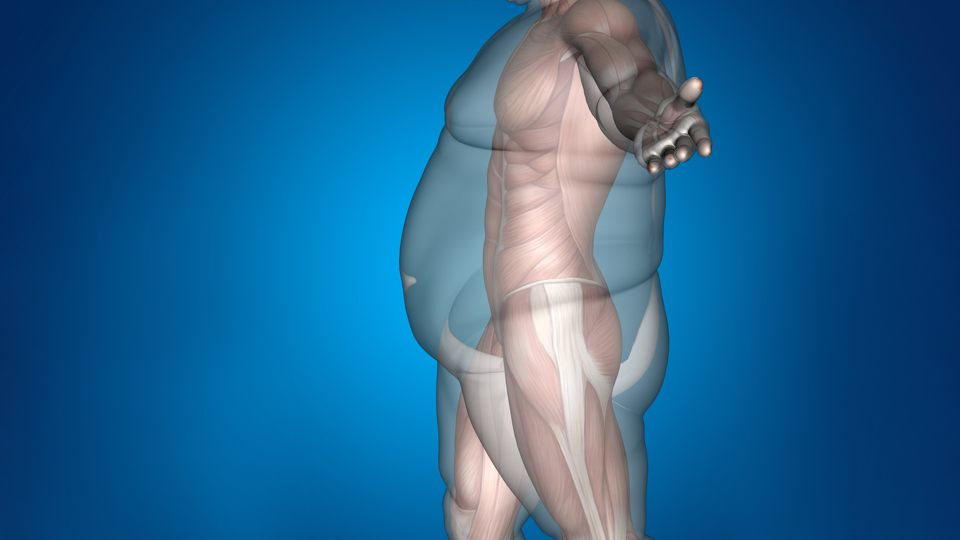 WHAT IS OBESITY?