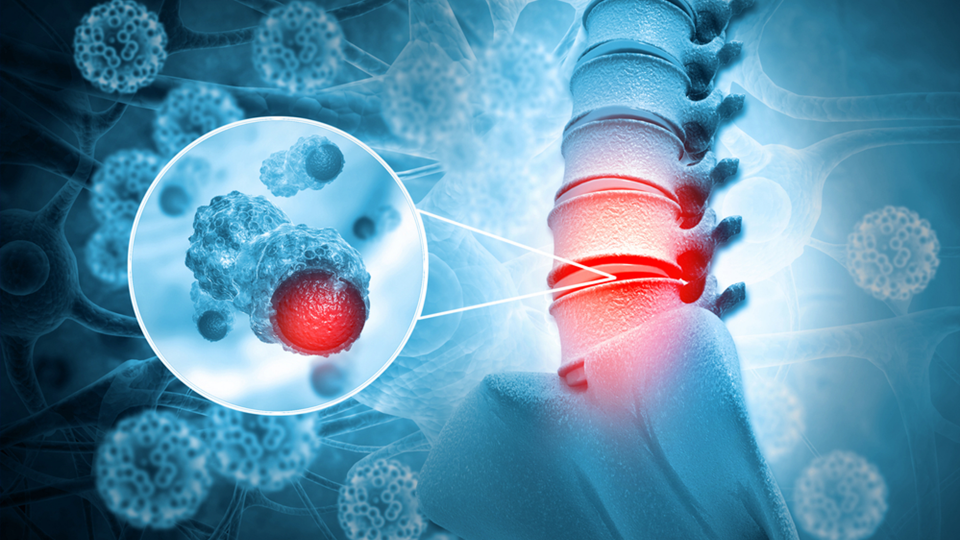 What is a spinal tumor?
