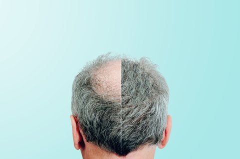 Hair Transplant in 20 Questions 1