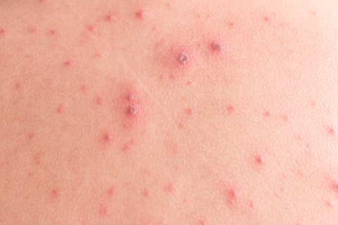 Monkeypox: How Is It Different From Chickenpox?  2