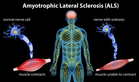 What is ALS? What are the stages and causes of ALS? 1