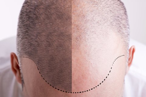 Hair Transplant in 20 Questions 3